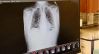 Lung cancer pill cuts risk of death by half: Study 
