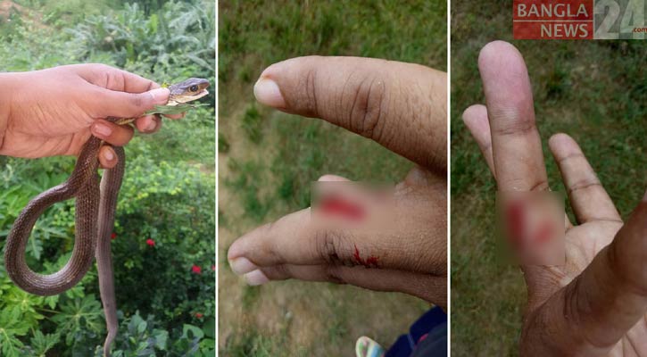 আদনানের আঙুলে জলপাইরঙা দাঁড়াশ সাপের কামড়। ছবি: বাংলানিউজ